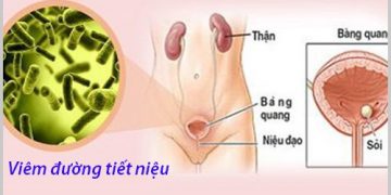 Viêm đường tiết niệu nữ: Nguyên nhân, triệu chứng, cách chữa