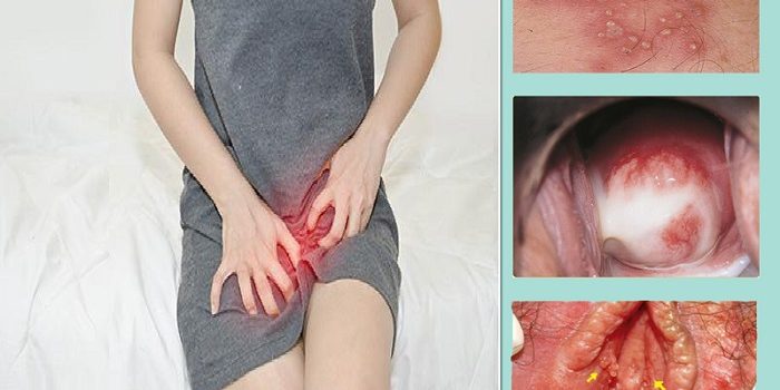 Nguyên nhân môi bé, âm đạo bị sưng lồi, ngứa ngáy khó chịu
