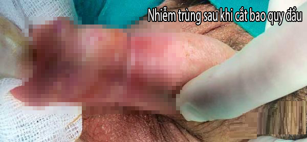 Hình ảnh nhiễm trùng sau khi cắt bao quy đầu 
