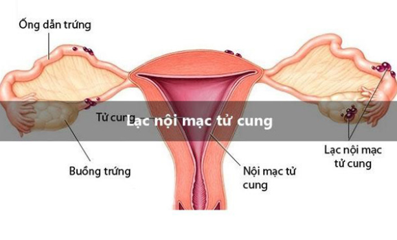Lạc nội mạc cổ tử cung: Triệu chứng & Điều trị