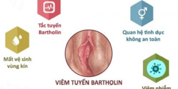 Viêm tuyến bartholin: Nguyên nhân và cách chữa